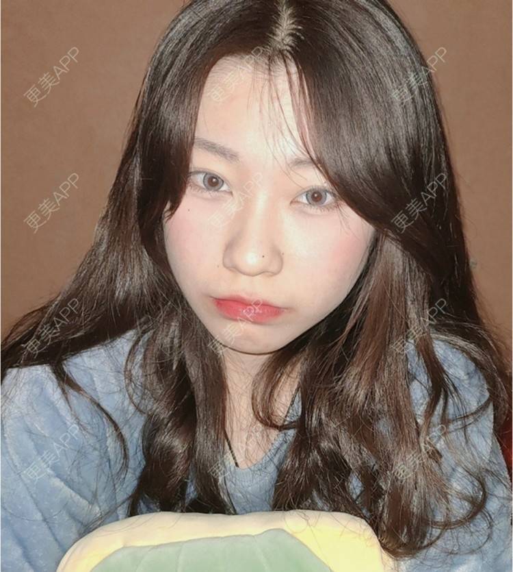 更美 - 更美用户7LPkqG2R1t的厚唇改薄经验 | 厚唇改薄 | 深圳
