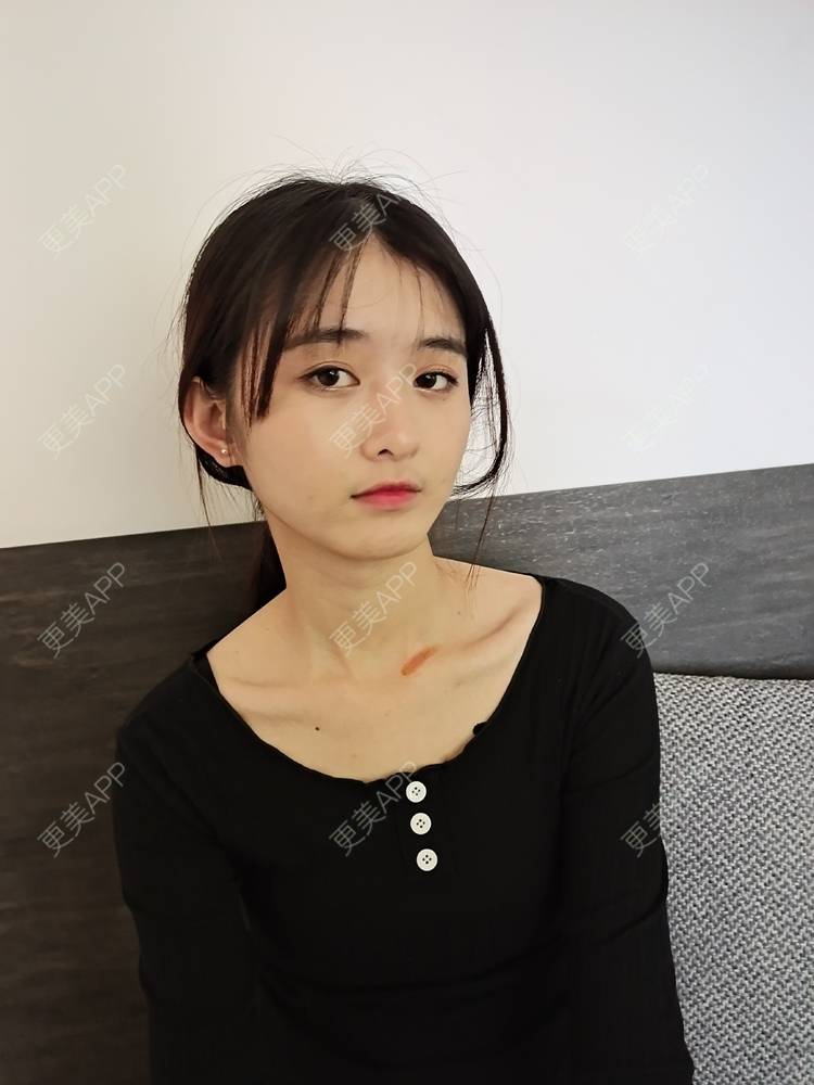 更美 - 更美用户Nk6w933b9g的激光淡疤经验 | 皮肤综合管理套餐 | 皮肤美容 | 激光淡疤 | 成都