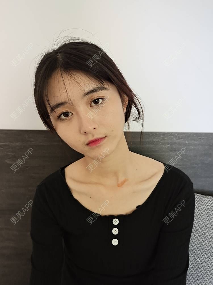 更美 - 更美用户Nk6w933b9g的激光淡疤经验 | 皮肤综合管理套餐 | 皮肤美容 | 激光淡疤 | 成都