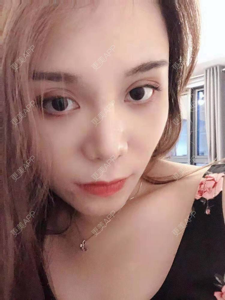 更美 - 小雯静的耳软骨隆鼻经验 | 北京 | 耳软骨隆鼻