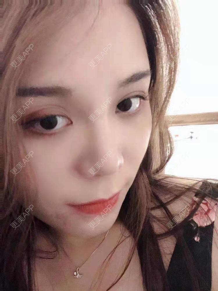 更美 - 小雯静的耳软骨隆鼻经验 | 北京 | 耳软骨隆鼻