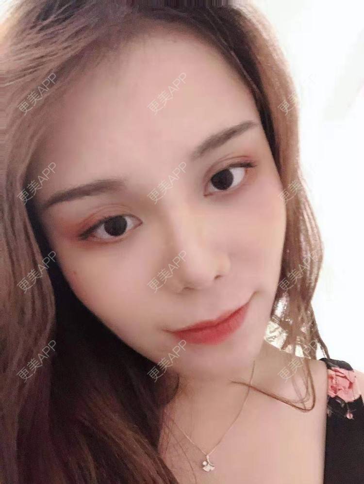 更美 - 小雯静的耳软骨隆鼻经验 | 北京 | 耳软骨隆鼻