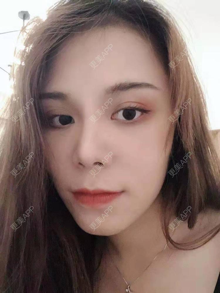 更美 - 小雯静的耳软骨隆鼻经验 | 北京 | 耳软骨隆鼻