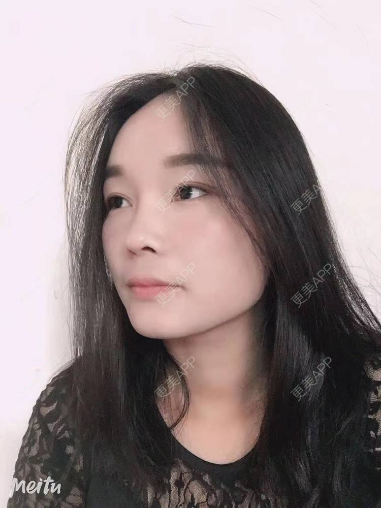 更美 - 见你好似见青山的鼻部多项经验 | 昆明 | 鼻部多项