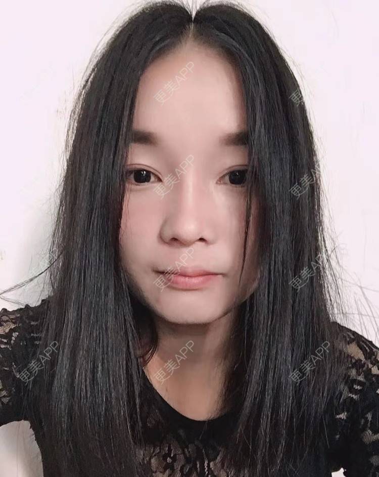 更美 - 见你好似见青山的鼻部多项经验 | 昆明 | 鼻部多项