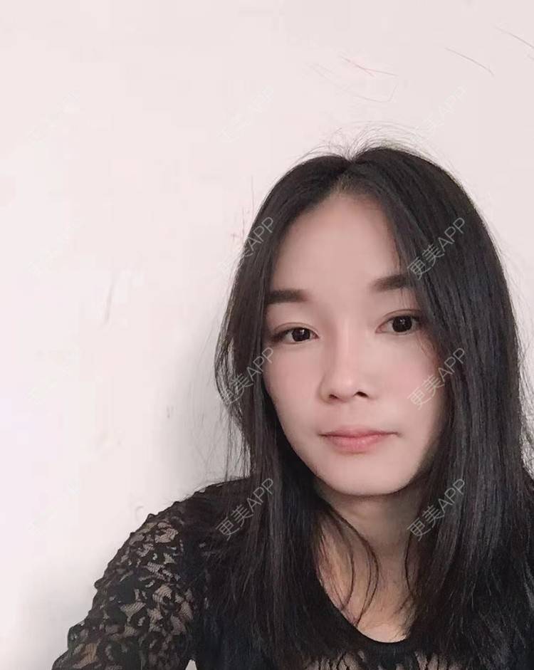 更美 - 见你好似见青山的鼻部多项经验 | 昆明 | 鼻部多项