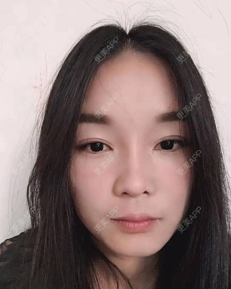 更美 - 见你好似见青山的鼻部多项经验 | 昆明 | 鼻部多项