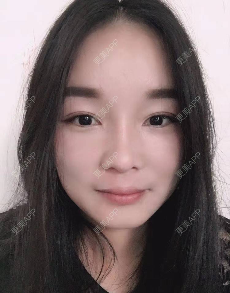 更美 - 见你好似见青山的鼻部多项经验 | 昆明 | 鼻部多项
