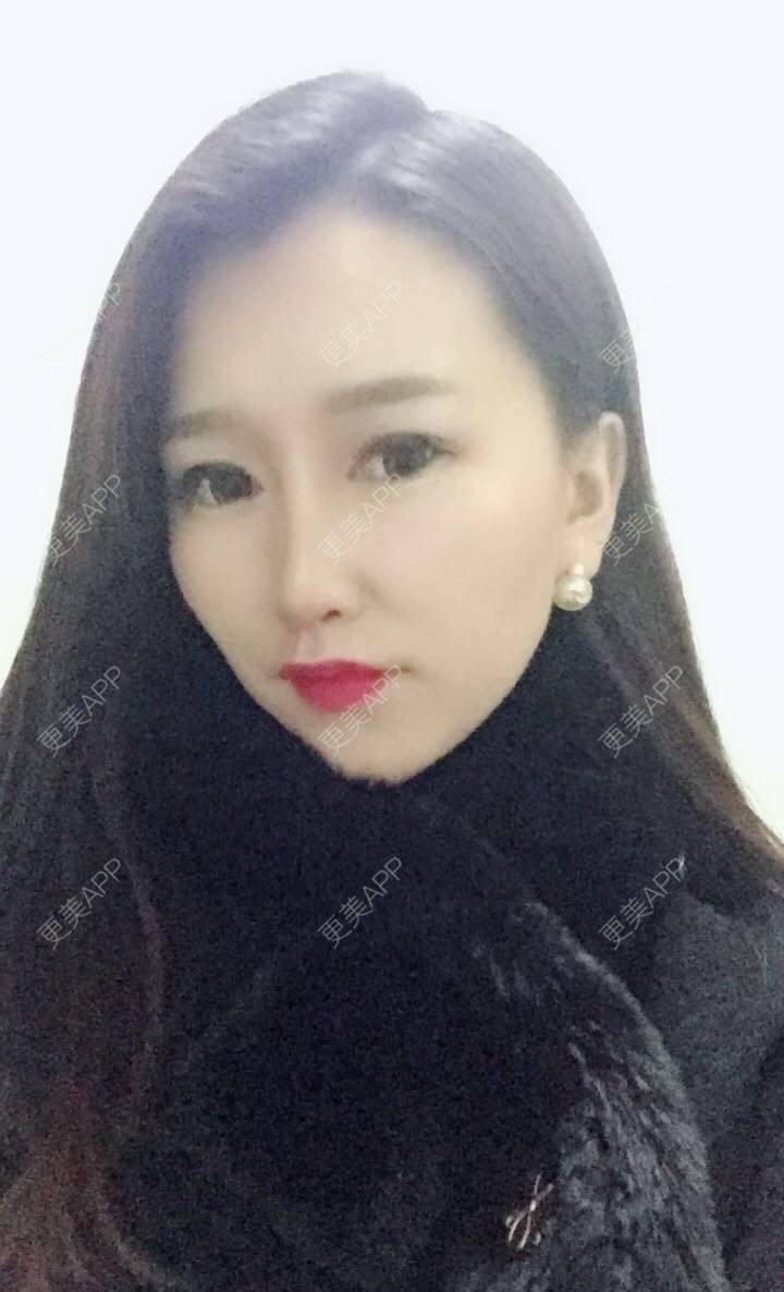 更美 - 听董了吗的真皮隆鼻经验 | 北京 | 真皮隆鼻