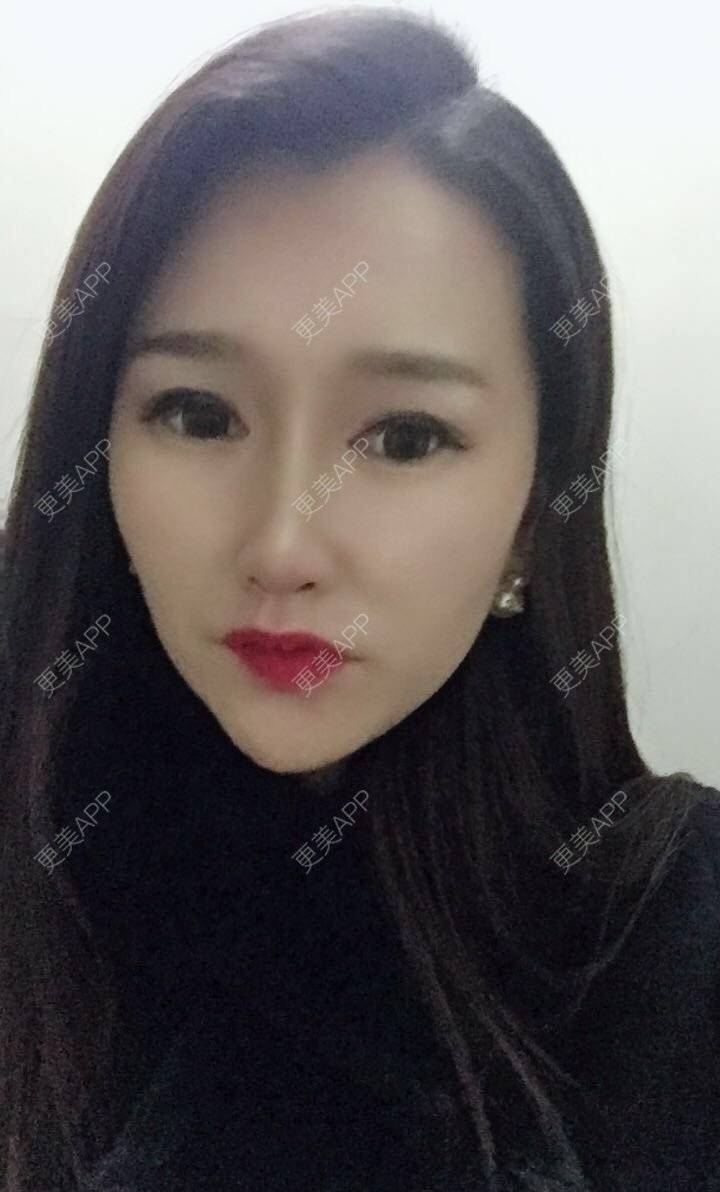 更美 - 听董了吗的真皮隆鼻经验 | 北京 | 真皮隆鼻