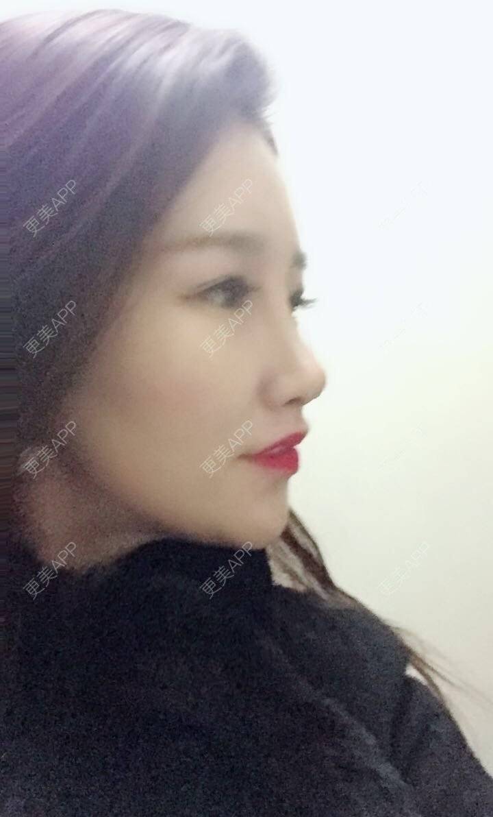 更美 - 听董了吗的真皮隆鼻经验 | 北京 | 真皮隆鼻