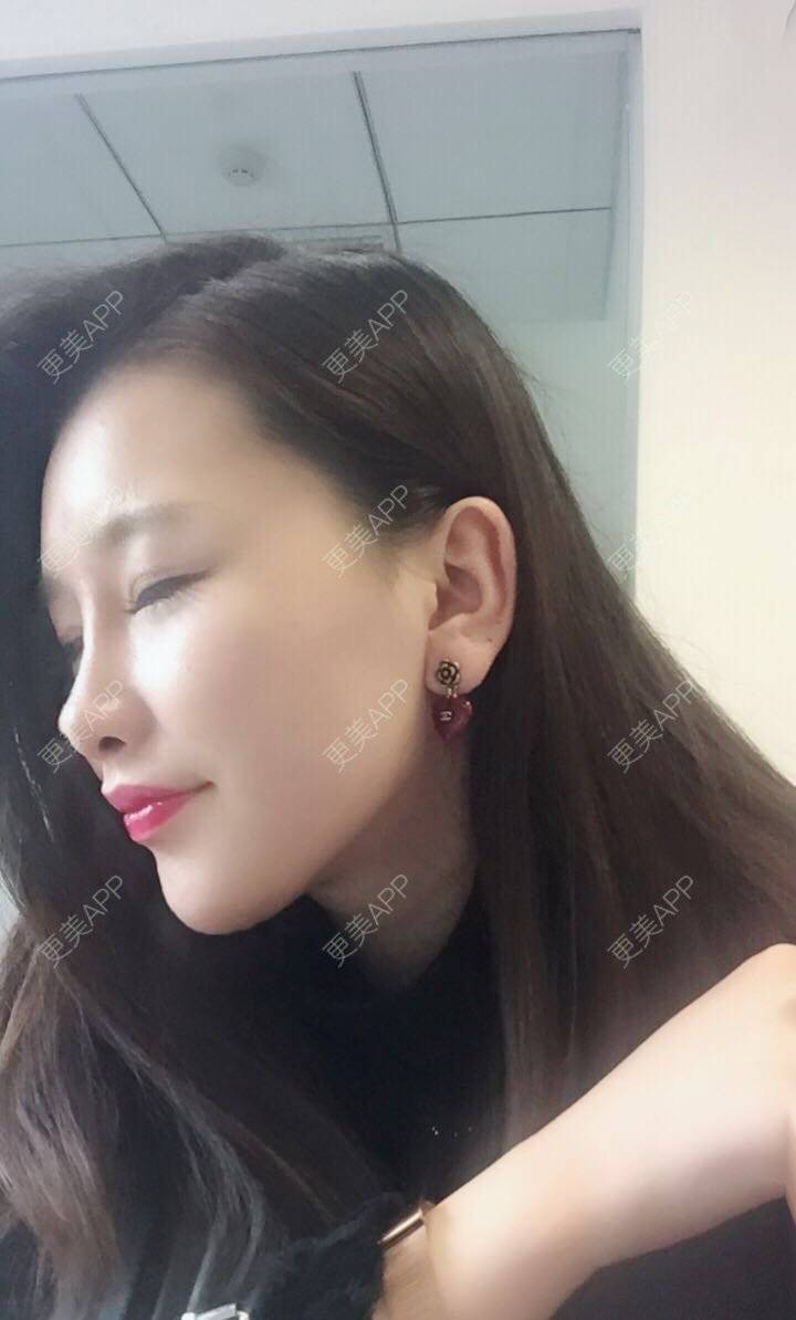 更美 - 听董了吗的真皮隆鼻经验 | 北京 | 真皮隆鼻