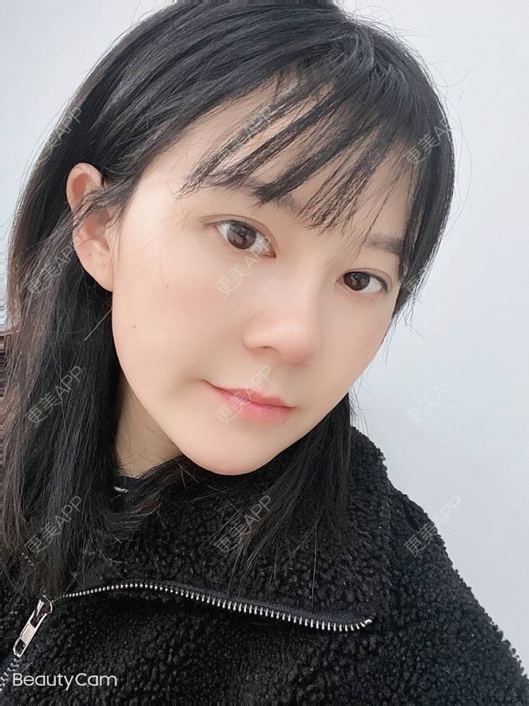 更美 - 更美用户prC91QaBHw的肋软骨隆鼻经验 | 信阳 | 肋软骨隆鼻