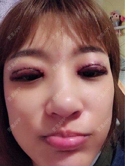 更美 - 更美用户4Iii004LB7的眼综合修复经验 | 眼综合修复 | 眼部修复 | 南京