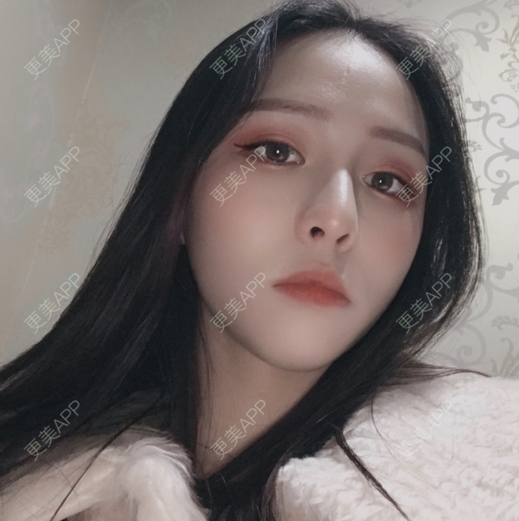 更美 - 更美用户npqbV13JPe的隆鼻经验 | 成都 | 视频日记 | 隆鼻