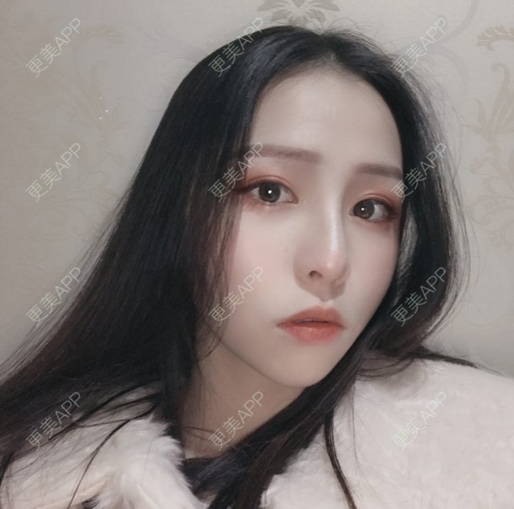 更美 - 更美用户npqbV13JPe的隆鼻经验 | 成都 | 视频日记 | 隆鼻