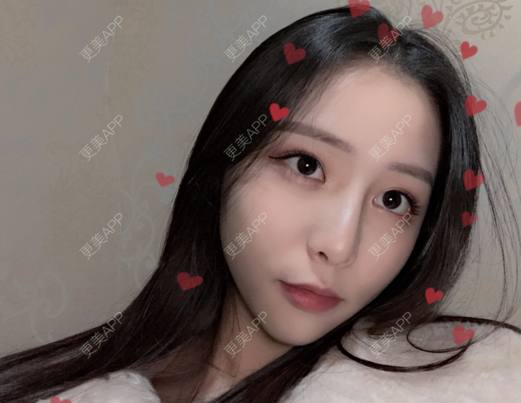 更美 - 更美用户npqbV13JPe的隆鼻经验 | 成都 | 视频日记 | 隆鼻