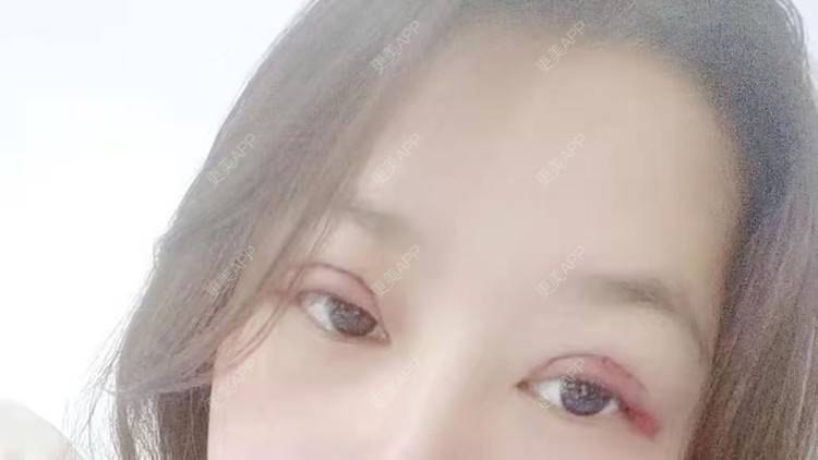 更美 - 更美用户ondaVC6pCZ的全切双眼皮经验 | 全切双眼皮