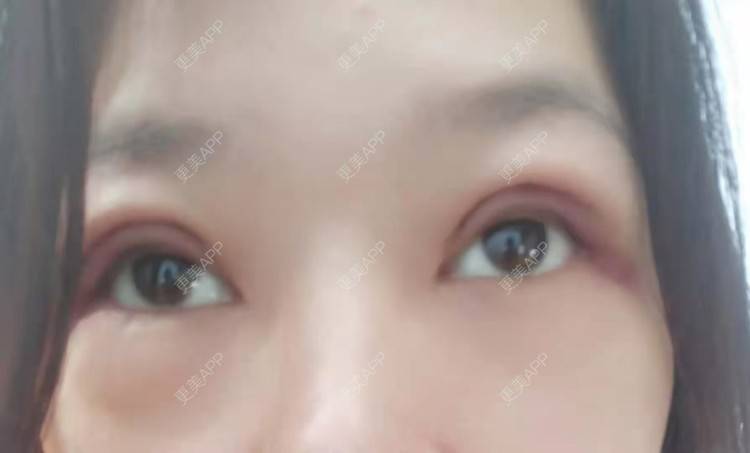 更美 - 更美用户ondaVC6pCZ的全切双眼皮经验 | 全切双眼皮