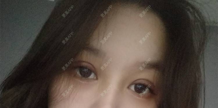 更美 - 更美用户ondaVC6pCZ的全切双眼皮经验 | 全切双眼皮