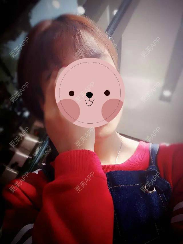 更美 - 最萌女生猎的阴唇整形经验 | 上海 | 阴唇整形