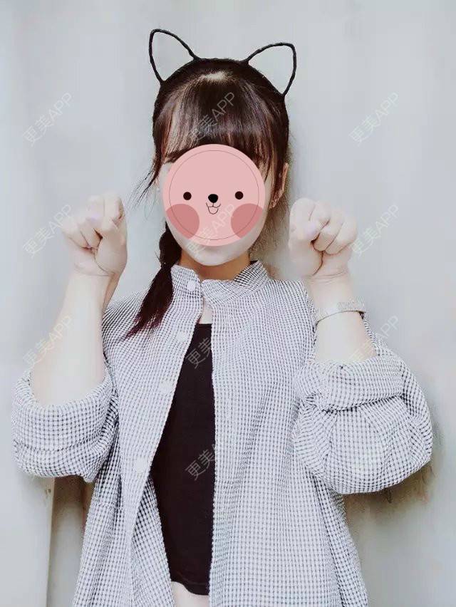 更美 - 最萌女生猎的阴唇整形经验 | 上海 | 阴唇整形