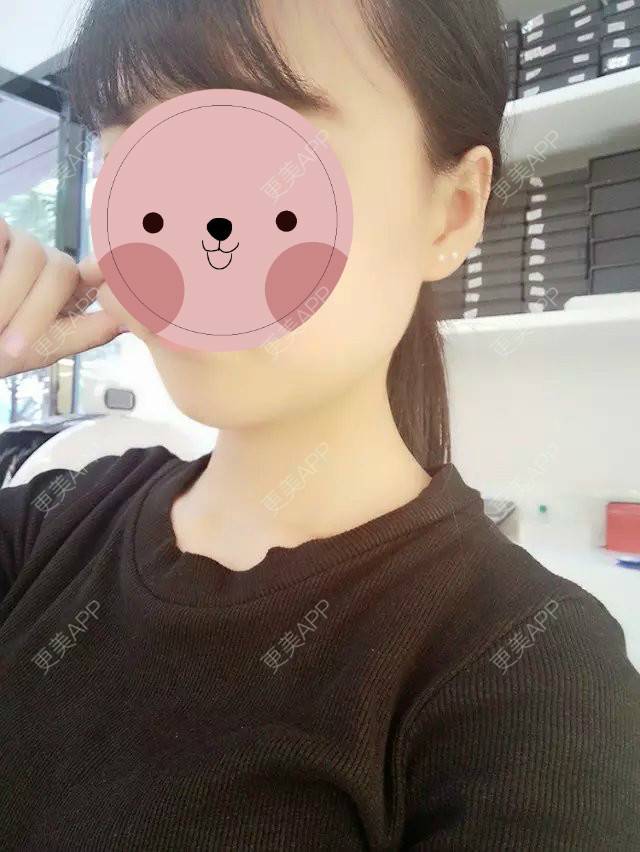 更美 - 最萌女生猎的阴唇整形经验 | 上海 | 阴唇整形