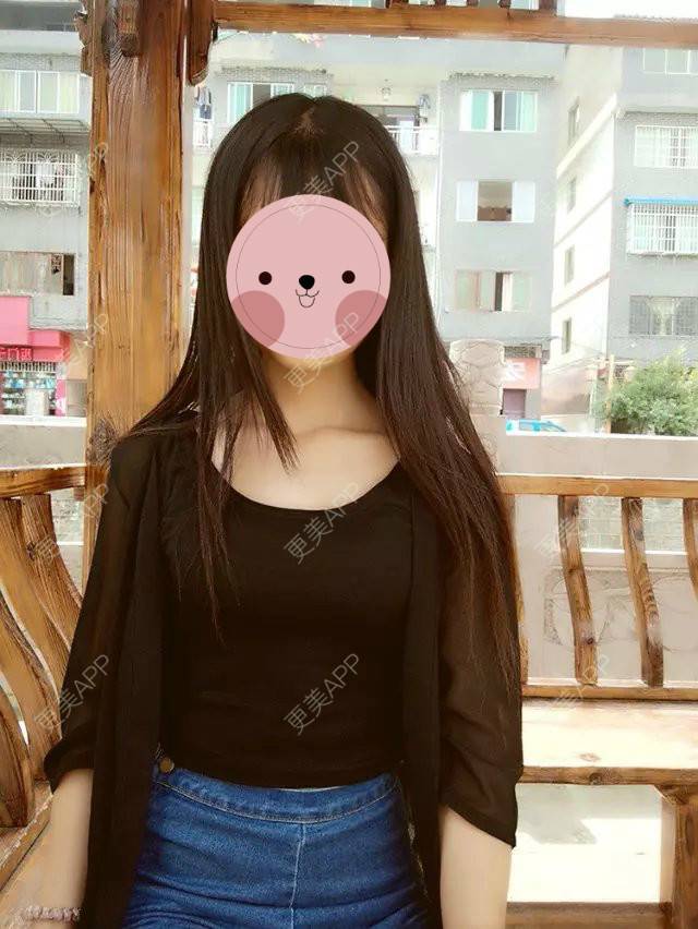 更美 - 最萌女生猎的阴唇整形经验 | 上海 | 阴唇整形