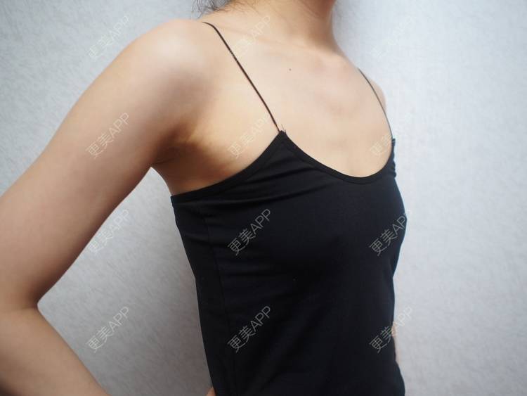 更美 - 更美用户nx90MyPvre的假体隆胸经验 | 假体隆胸