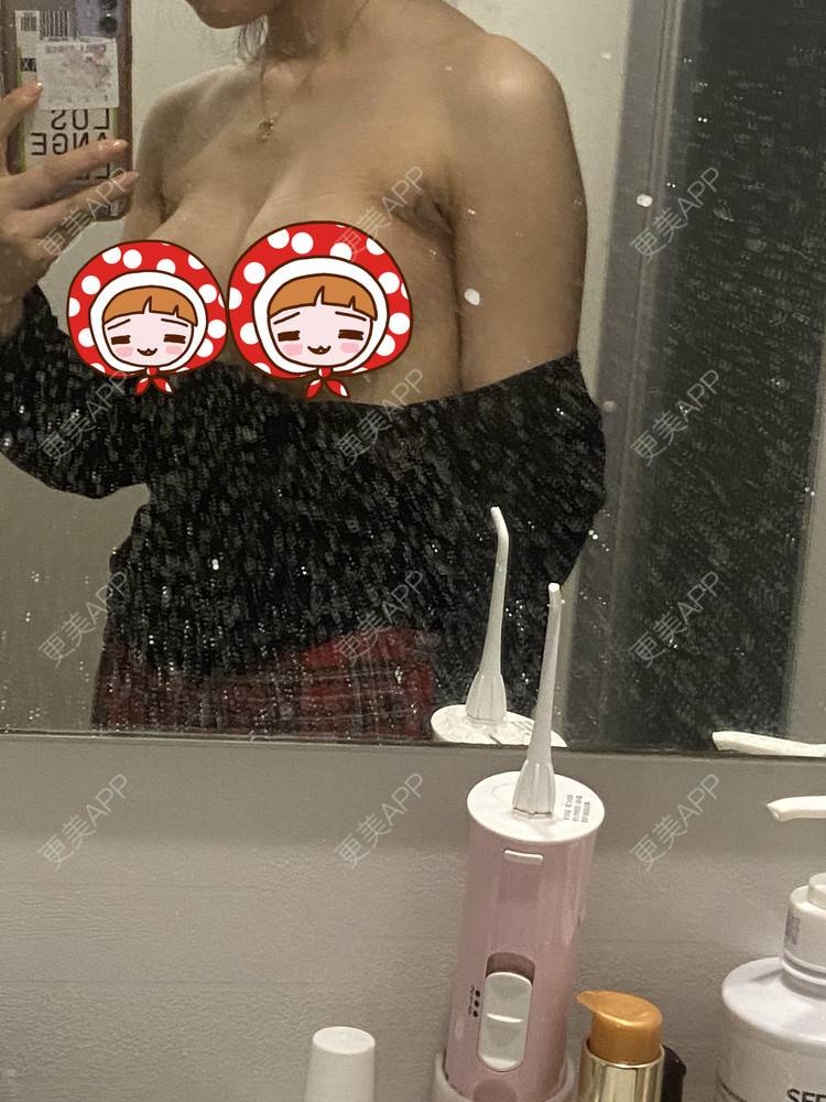 更美 - 更美用户nx90MyPvre的假体隆胸经验 | 假体隆胸