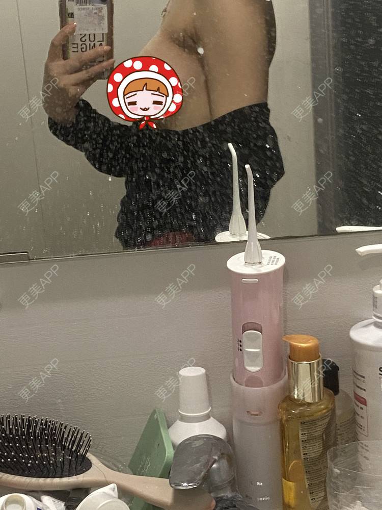 更美 - 更美用户nx90MyPvre的假体隆胸经验 | 假体隆胸