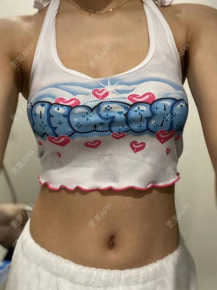 更美 - 更美用户nx90MyPvre的假体隆胸经验 | 假体隆胸
