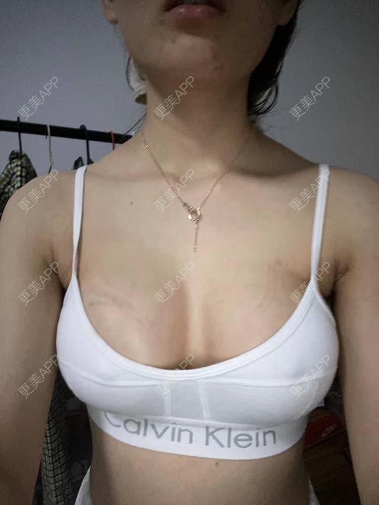 更美 - 更美用户nx90MyPvre的假体隆胸经验 | 假体隆胸