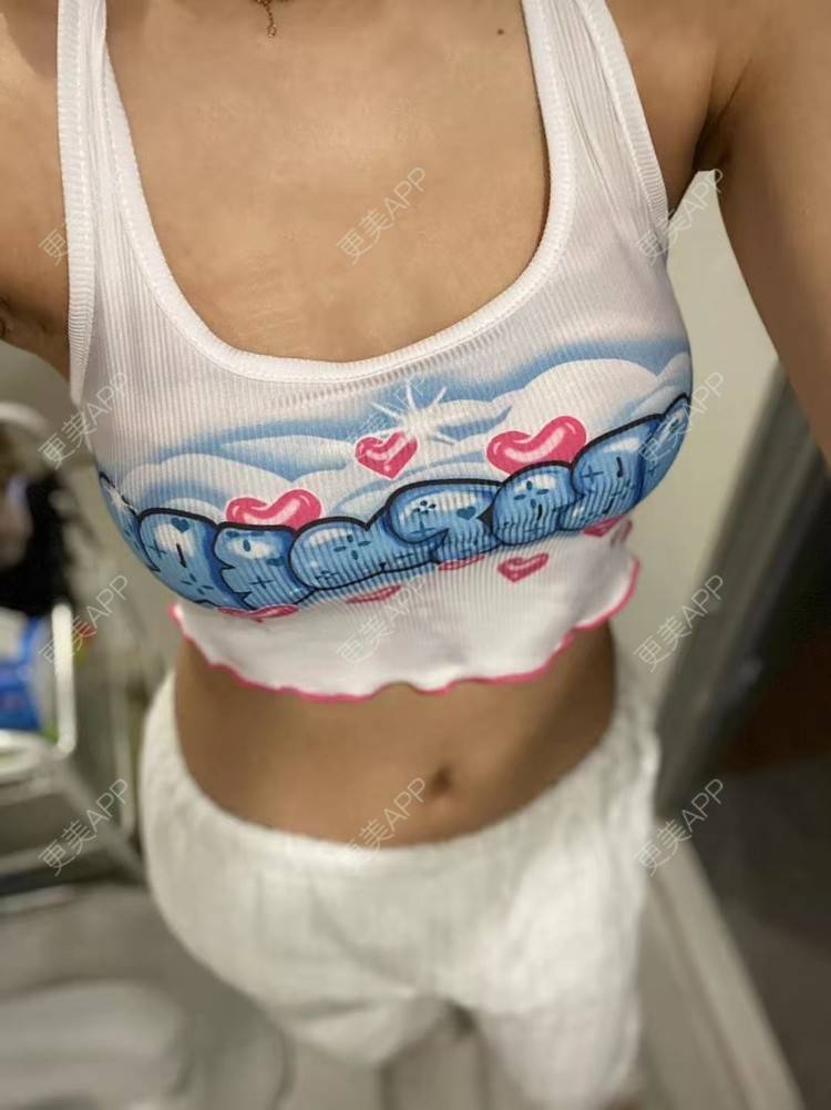 更美 - 更美用户nx90MyPvre的假体隆胸经验 | 假体隆胸