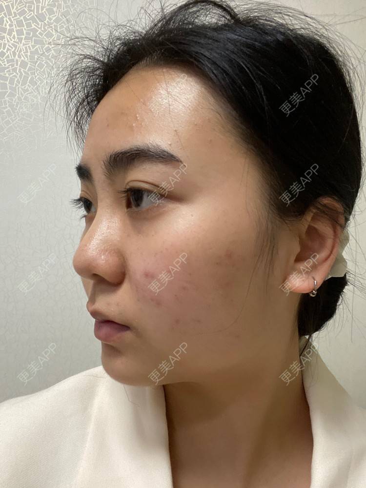 更美 - 昀昀一水间的颧骨颧弓整形经验 | 颧骨颧弓整形 | 下颌角整形 | 武汉