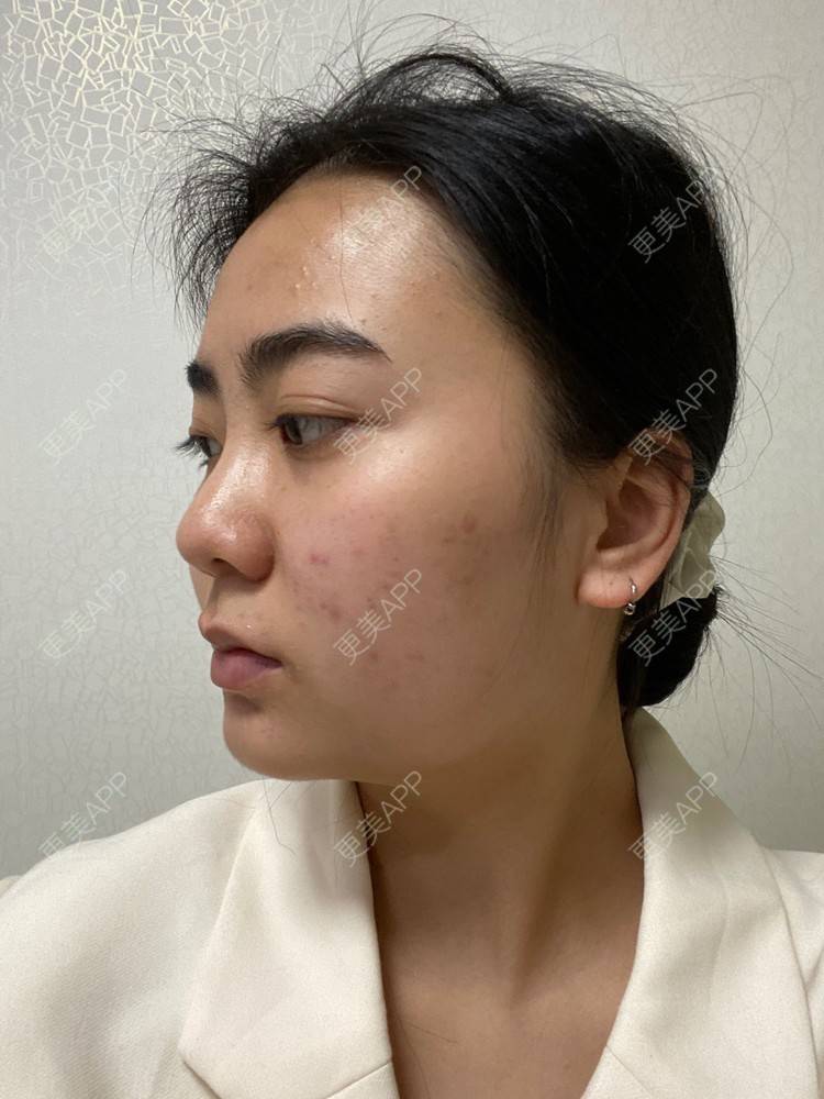 更美 - 昀昀一水间的颧骨颧弓整形经验 | 颧骨颧弓整形 | 下颌角整形 | 武汉