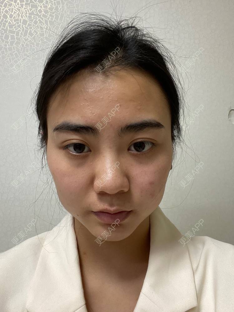 更美 - 昀昀一水间的颧骨颧弓整形经验 | 颧骨颧弓整形 | 下颌角整形 | 武汉