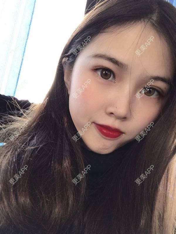 更美 - 更美用户mpyvE48XXs的眼部多项经验 | 郑州 | 眼部多项