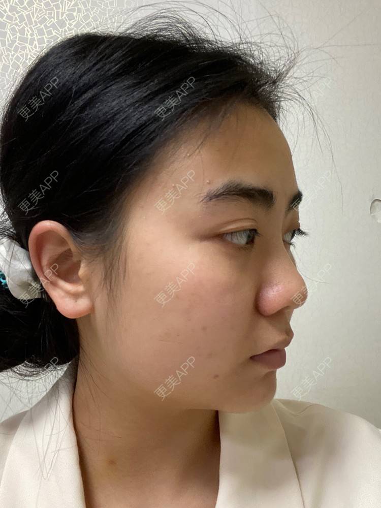 更美 - 昀昀一水间的颧骨颧弓整形经验 | 颧骨颧弓整形 | 下颌角整形 | 武汉