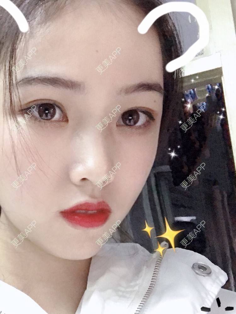 更美 - 更美用户mpyvE48XXs的眼部多项经验 | 郑州 | 眼部多项