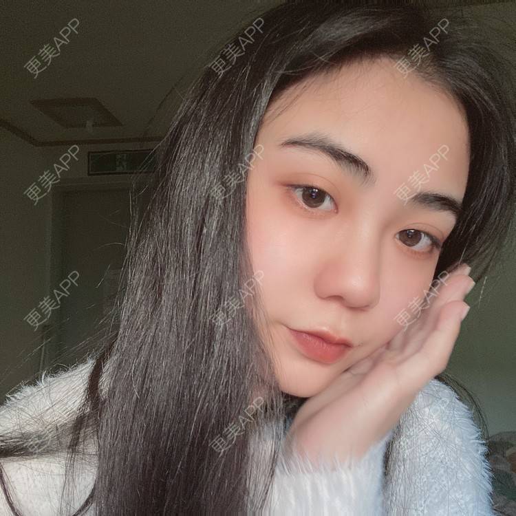 更美 - 昀昀一水间的颧骨颧弓整形经验 | 颧骨颧弓整形 | 下颌角整形 | 武汉