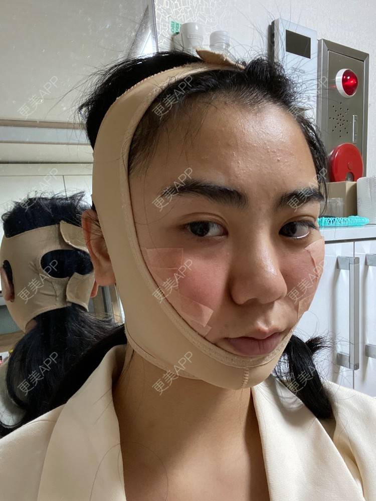 更美 - 昀昀一水间的颧骨颧弓整形经验 | 颧骨颧弓整形 | 下颌角整形 | 武汉