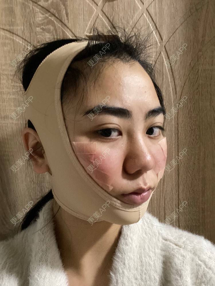 更美 - 昀昀一水间的颧骨颧弓整形经验 | 颧骨颧弓整形 | 下颌角整形 | 武汉