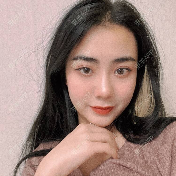 更美 - 昀昀一水间的颧骨颧弓整形经验 | 颧骨颧弓整形 | 下颌角整形 | 武汉