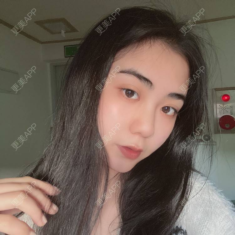 更美 - 昀昀一水间的颧骨颧弓整形经验 | 颧骨颧弓整形 | 下颌角整形 | 武汉