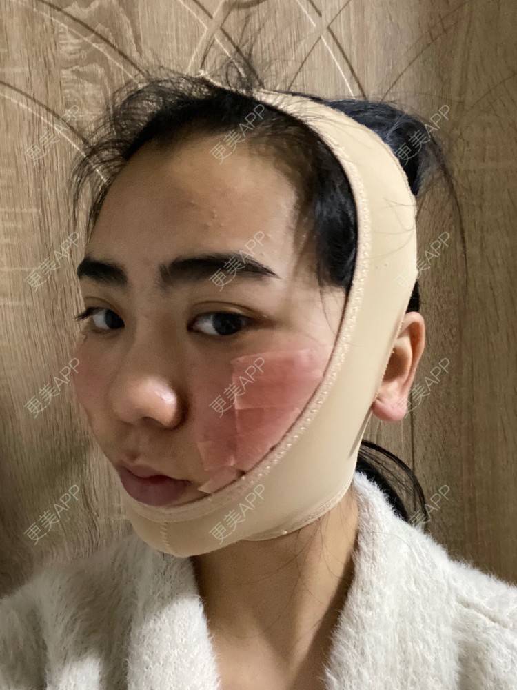 更美 - 昀昀一水间的颧骨颧弓整形经验 | 颧骨颧弓整形 | 下颌角整形 | 武汉