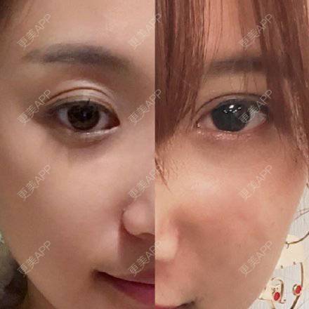 更美 - 更美用户4Iii004LB7的眼综合修复经验 | 眼综合修复 | 眼部修复 | 南京