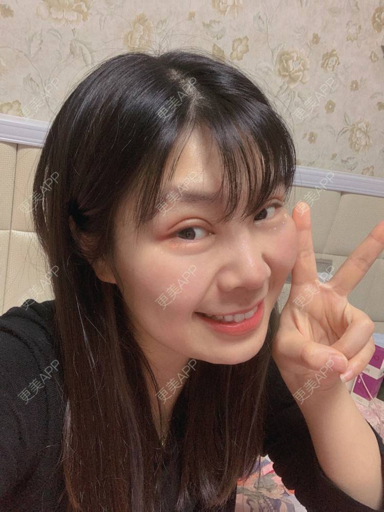 更美 - 更美我君的全切双眼皮经验 | 全切双眼皮