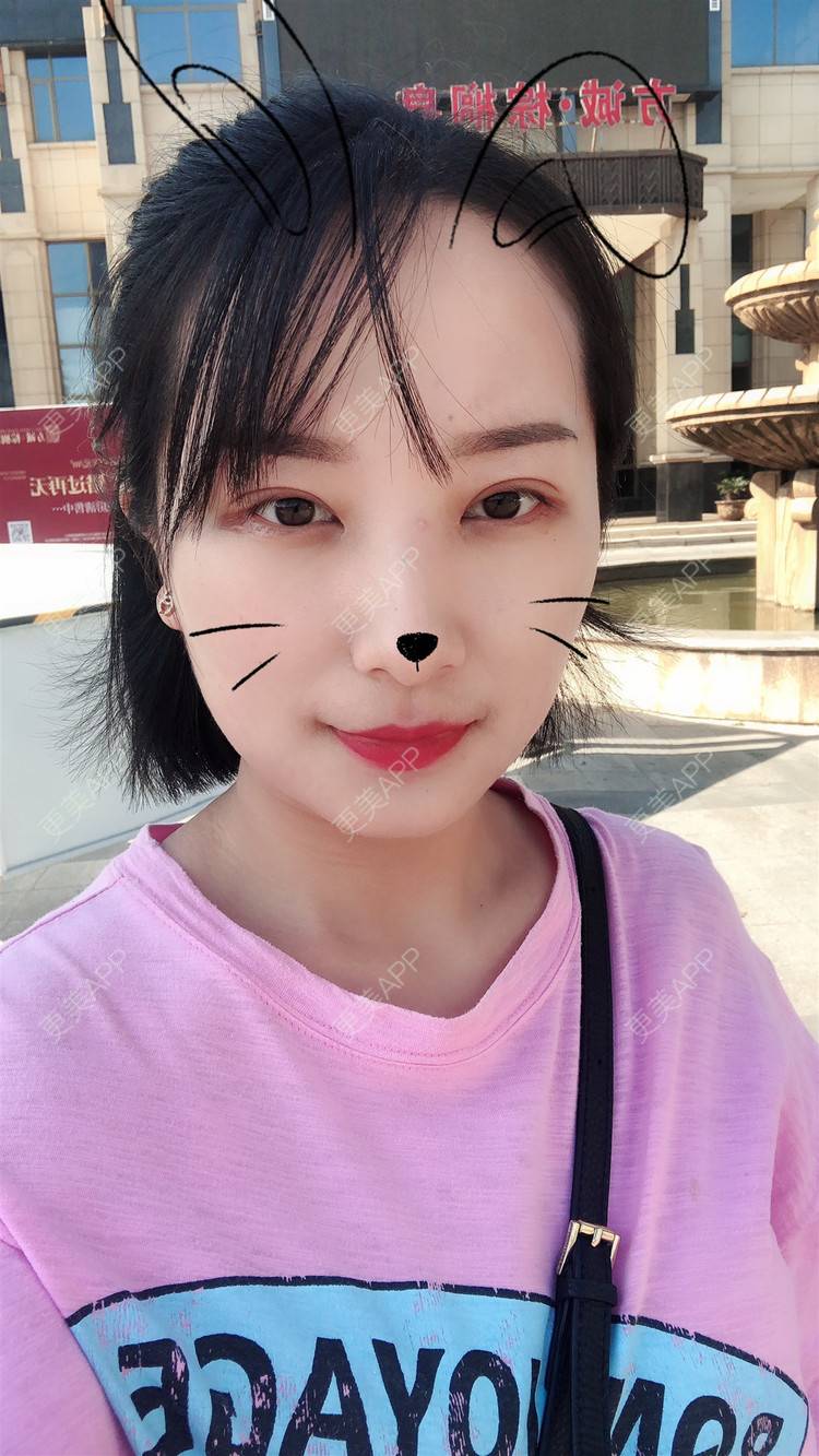 更美 - 更美用户YLfRjv9iN9的全切双眼皮经验 | 郑州 | 全切双眼皮