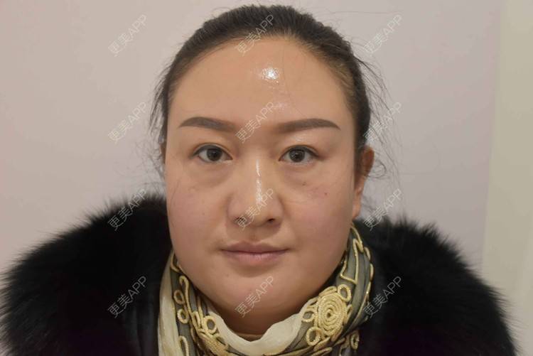 更美 - 更美用户Z28pYLcJqq的内切去眼袋经验 | 激光去眼袋 | 内切去眼袋 | 眶隔脂肪释放 | 北京